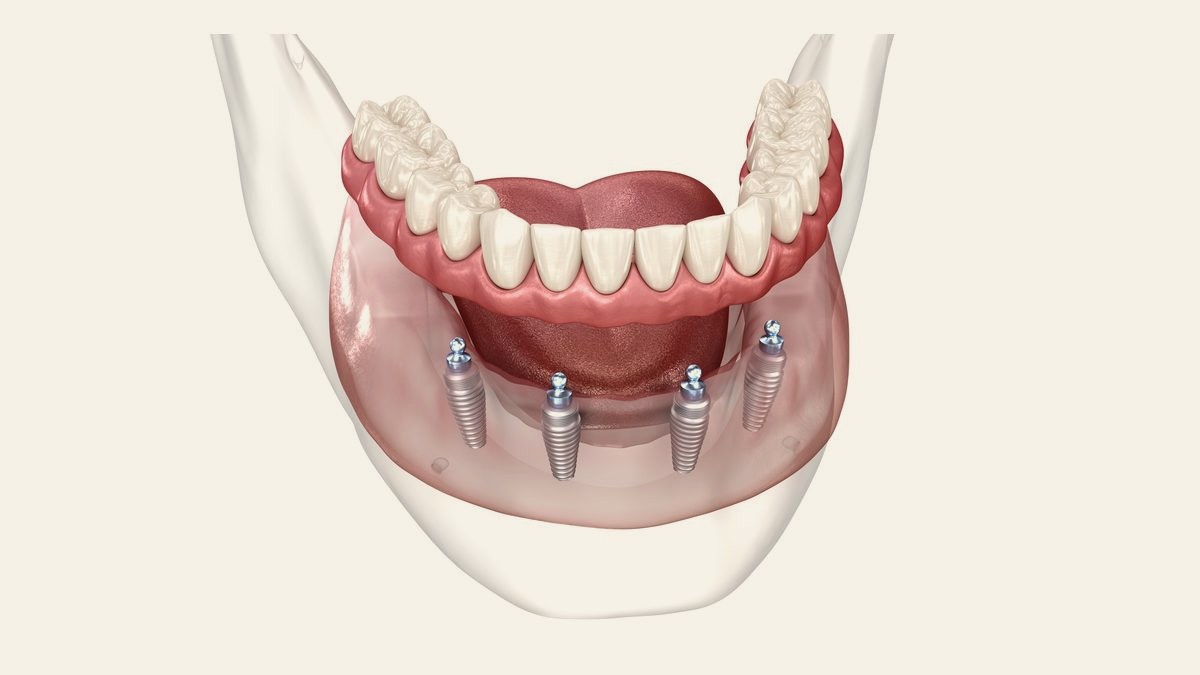 Átlátszó állcsontmodell rögzített fogívvel négy implantátumon